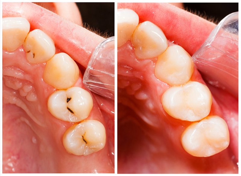 Fillings Waipahu, HI