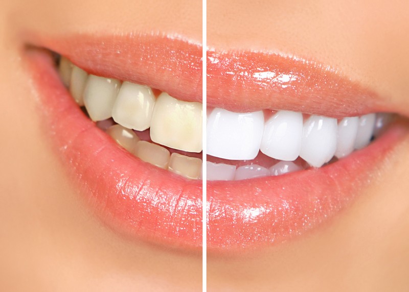 Teeth Whitening Waipahu, HI