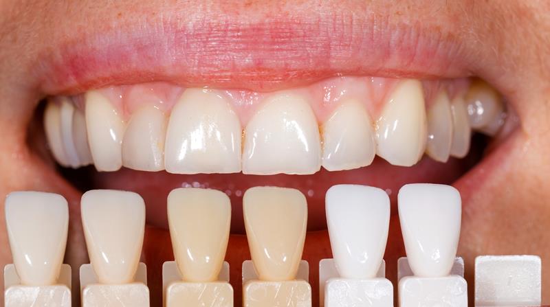 Veneers Waipahu, HI